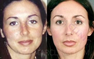 Before FAMI/Six Months After FAMI