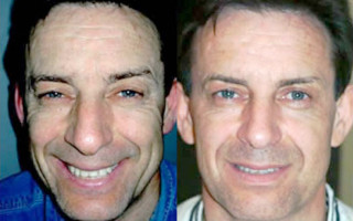 FAMI for men results