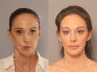 FAMI non-surgical facelift one