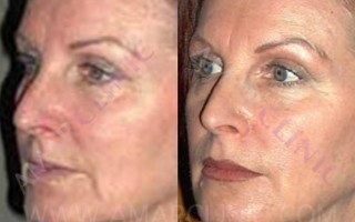 Before/After FAMI Facelif