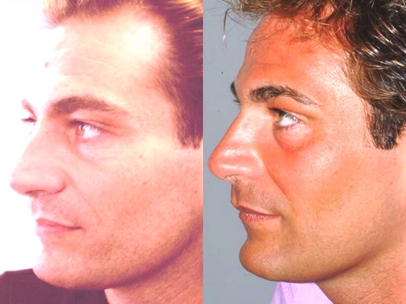 full_face_fami3_left
