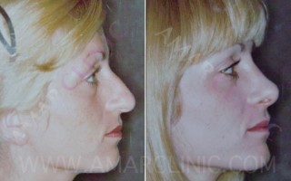 cosmetic Rhinoplasty Nosejob