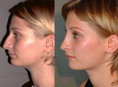 Nose Surgery before and after