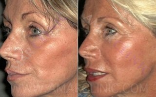 FAMI non-surgical facelift eight